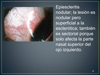 49
Epiescleritis
nodular; la lesión es
nodular pero
superficial a la
esclerótica; también
es sectorial porque
solo afecta la parte
nasal superior del
ojo izquierdo.
 