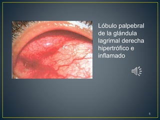 Lóbulo palpebral
de la glándula
lagrimal derecha
hipertrófico e
inflamado
5
 