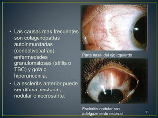 • Las causas mas frecuentes
son colagenopatías
autoinmunitarias
(conectivopatías),
enfermedades
granulomatosas (sífilis o
TBC) y gota o
hiperuricemia.
• La escleritis anterior puede
ser difusa, sectorial,
nodular o necrosante.
51
Parte nasal del ojo izquierdo
Escleritis nodular con
adelgazmiento escleral
 