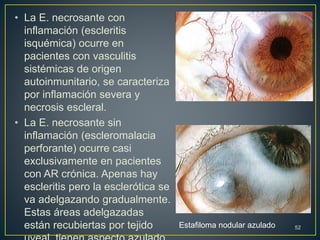 • La E. necrosante con
inflamación (escleritis
isquémica) ocurre en
pacientes con vasculitis
sistémicas de origen
autoinmunitario, se caracteriza
por inflamación severa y
necrosis escleral.
• La E. necrosante sin
inflamación (escleromalacia
perforante) ocurre casi
exclusivamente en pacientes
con AR crónica. Apenas hay
escleritis pero la esclerótica se
va adelgazando gradualmente.
Estas áreas adelgazadas
están recubiertas por tejido 52Estafiloma nodular azulado
 