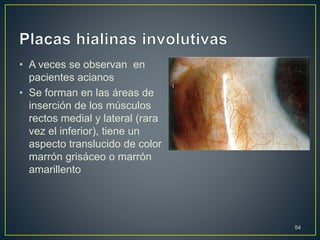 • A veces se observan en
pacientes acianos
• Se forman en las áreas de
inserción de los músculos
rectos medial y lateral (rara
vez el inferior), tiene un
aspecto translucido de color
marrón grisáceo o marrón
amarillento
54
 