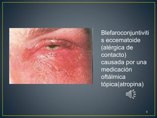 Blefaroconjuntiviti
s eccematoide
(alérgica de
contacto)
causada por una
medicación
oftálmica
tópica(atropina)
6
 