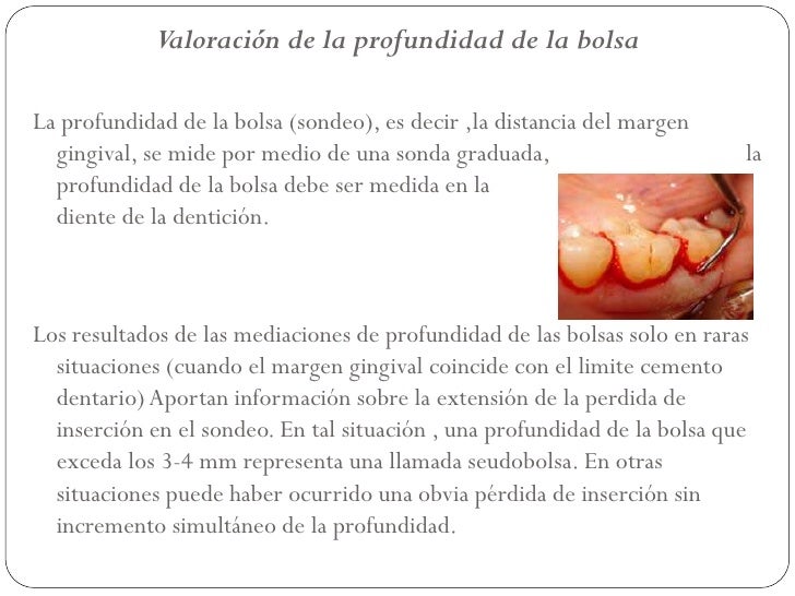 Exploracion de pacientes periodontales
