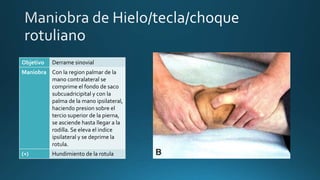 Objetivo Derrame sinovial
Maniobra Con la region palmar de la
mano contralateral se
comprime el fondo de saco
subcuadricipital y con la
palma de la mano ipsilateral,
haciendo presion sobre el
tercio superior de la pierna,
se asciende hasta llegar a la
rodilla. Se eleva el indice
ipsilateral y se deprime la
rotula.
(+) Hundimiento de la rotula
 