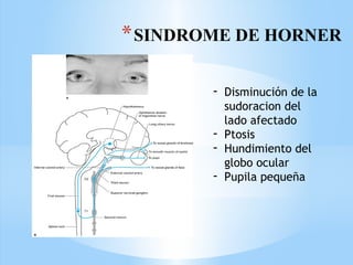 *SINDROME DE HORNER
- Disminución de la
sudoracion del
lado afectado
- Ptosis
- Hundimiento del
globo ocular
- Pupila pequeña
 
