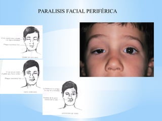 PARALISIS FACIAL PERIFÉRICA
 