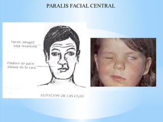PARALIS FACIAL CENTRAL
 