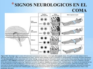 *SIGNOS NEUROLOGICOS EN EL
COMA
Figure 10–2. Neurologic signs in coma with downward transtentorial herniation. In the early diencephalic phase, the pupils are small (about 2 mm in
diameter) and reactive, reflex eye movements are intact, and the motor response to pain is purposeful or semipurposeful (localizing) and often asymmetric.
The late diencephalic phase is associated with similar findings, except that painful stimulation results in decorticate (flexor) posturing, which may also be
asymmetric. With midbrain involvement, the pupils are fixed and midsized (about 5 mm in diameter), reflex adduction of the eyes is impaired, and pain
elicits decerebrate (extensor) posturing. Progression to involve the pons or medulla also produces fixed, midsized pupils, but these are accompanied by loss
of reflex abduction as well as adduction of the eyes and by no motor response or only leg flexion upon painful stimulation. Note that although a lesion
restricted to the pons produces pinpoint pupils as a result of the destruction of descending sympathetic (pupillodilator) pathways, downward herniation to
the pontine level is associated with midsized pupils. This happens because herniation also interrupts parasympathetic (pupilloconstrictor) fibers in the
oculomotor (III) nerve.
 