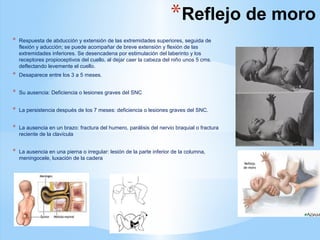 *Reflejo de moro
* Respuesta de abducción y extensión de las extremidades superiores, seguida de
flexión y aducción; se puede acompañar de breve extensión y flexión de las
extremidades inferiores. Se desencadena por estimulación del laberinto y los
receptores propioceptivos del cuello, al dejar caer la cabeza del niño unos 5 cms.
deflectando levemente el cuello.
* Desaparece entre los 3 a 5 meses.
* Su ausencia: Deficiencia o lesiones graves del SNC
* La persistencia después de los 7 meses: deficiencia o lesiones graves del SNC.
* La ausencia en un brazo: fractura del humero, parálisis del nervio braquial o fractura
reciente de la clavícula
* La ausencia en una pierna o irregular: lesión de la parte inferior de la columna,
meningocele, luxación de la cadera
 