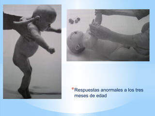 *Respuestas anormales a los tres
meses de edad
 