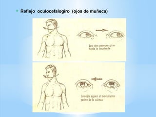  Reflejo oculocefalogiro (ojos de muñeca)
 