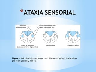 *ATAXIA SENSORIAL
Figure.- Principal sites of spinal cord disease (shading) in disorders
producing sensory ataxia.
 