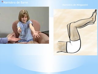 *Maniobra de Barre
Maniobra de Mingazzini
 