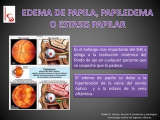 Rubén A. Lanosa. Sección 4, síndromes y patologías .
Semiología medica de Argente y Álvarez.
Es el hallazgo mas importante del SHE y
obliga a la realización sistémica del
fondo de ojo en cualquier paciente que
se sospeche que lo padece.
El edema de papila se debe a la
hipertensión de la vaina del nervio
óptico y a la estasis de la vena
oftálmica.
 