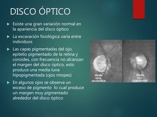 DISCO ÓPTICO
 Existe una gran variación normal en
la apariencia del disco óptico
 La excavación fisiológica varía entre
individuos
 Las capas pigmentadas del ojo,
epitelio pigmentado de la retina y
coroides, con frecuencia no alcanzan
el margen del disco óptico, esto
produce una media luna
hipopigmentada (ojos miopes)
 En algunos ojos se observa un
exceso de pigmento lo cual produce
un margen muy pigmentado
alrededor del disco óptico
 