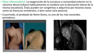 • Tórax cifoescoliótico: La exageración de la curvatura a concavidad anterior en la
columna dorsal (cifosis) habitualmente se combina con la desviación lateral de la
misma (escoliosis). Éstas pueden ser congénitas o adquirirse por lesiones óseas
como las fracturas vertebrales, o bien como vicio postural.
• Cuasimodo, el jorobado de Notre Dame, es uno de los más conocidos
portadores.
 