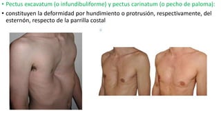 • Pectus excavatum (o infundibuliforme) y pectus carinatum (o pecho de paloma):
• constituyen la deformidad por hundimiento o protrusión, respectivamente, del
esternón, respecto de la parrilla costal
 