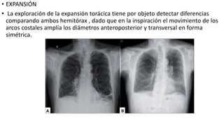 • EXPANSIÓN
• La exploración de la expansión torácica tiene por objeto detectar diferencias
comparando ambos hemitórax , dado que en la inspiración el movimiento de los
arcos costales amplía los diámetros anteroposterior y transversal en forma
simétrica.
 