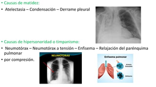 • Causas de matidez:
• Atelectasia – Condensación – Derrame pleural
• Causas de hipersonoridad o timpanismo:
• Neumotórax – Neumotórax a tensión – Enfisema – Relajación del parénquima
pulmonar
• por compresión.
 