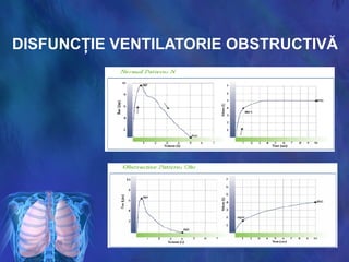 DISFUNCŢIE VENTILATORIE OBSTRUCTIVĂ
 