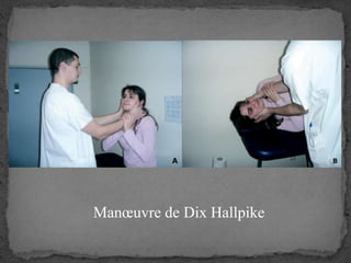 Manœuvre de Dix Hallpike
 