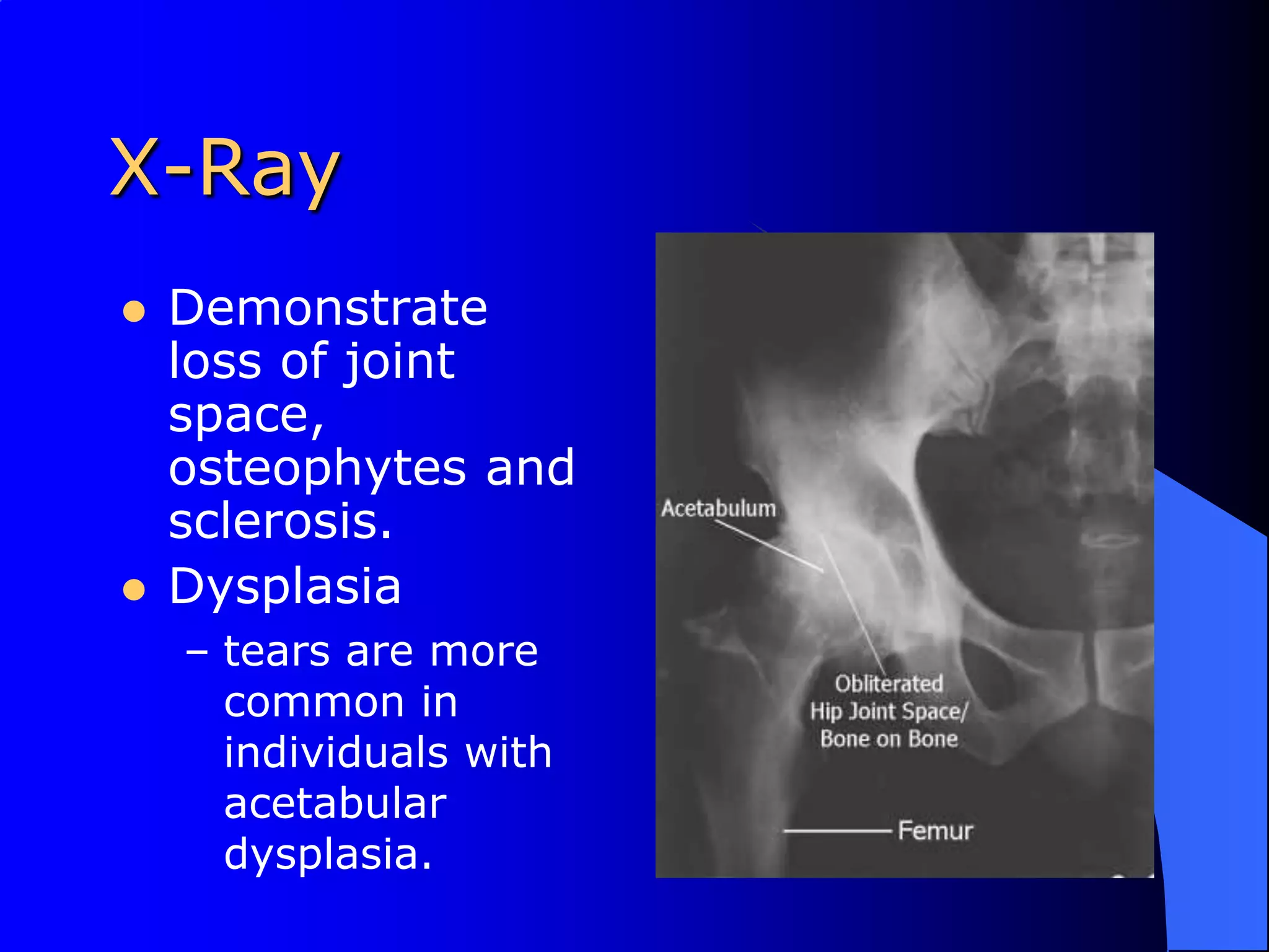 X-RayDemonstrate loss of joint space, osteophytes and sclerosis.Dysplasiatears are more common in individuals with acetabular dysplasia.