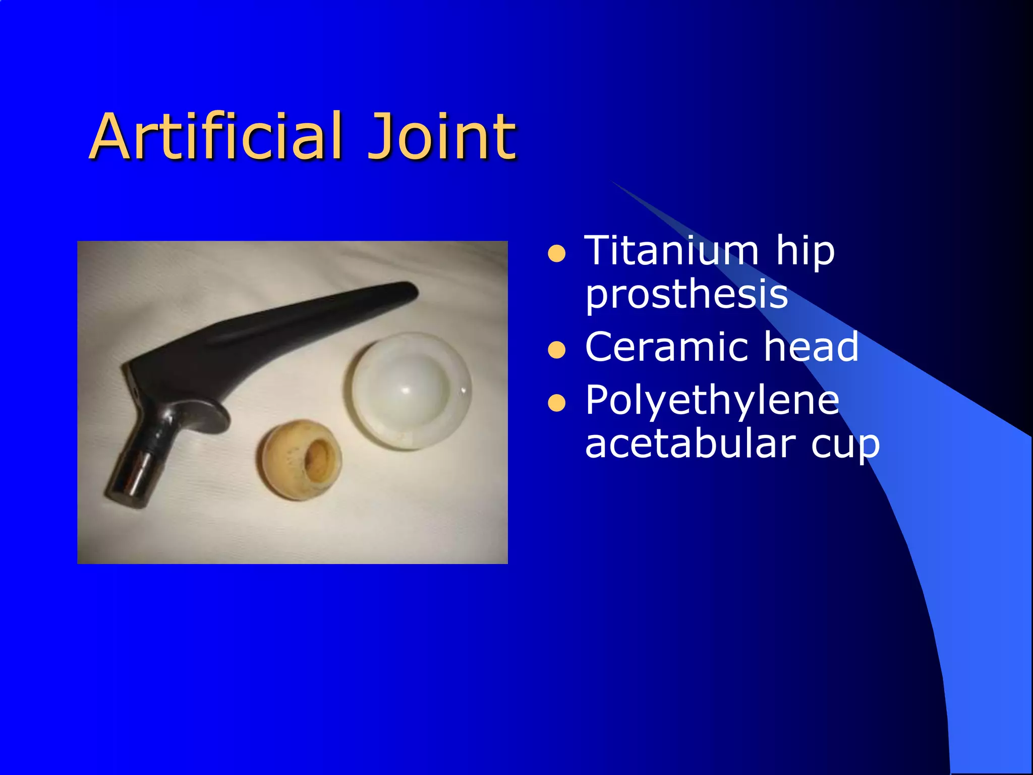 Artificial JointTitanium hip prosthesisCeramic headPolyethylene acetabular cup