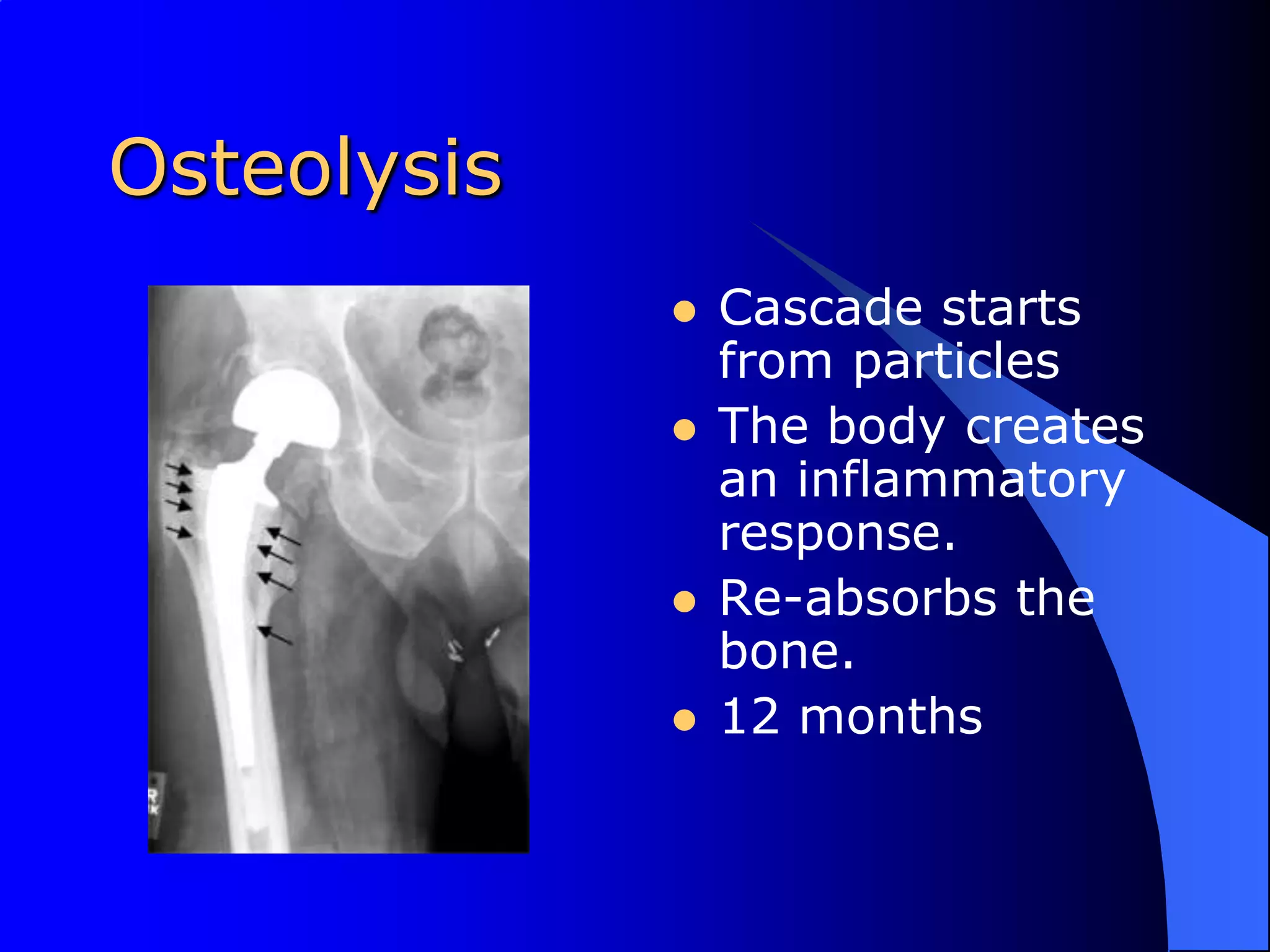 OsteolysisCascade starts from particlesThe body creates an inflammatory response.Re-absorbs the bone. 12 months