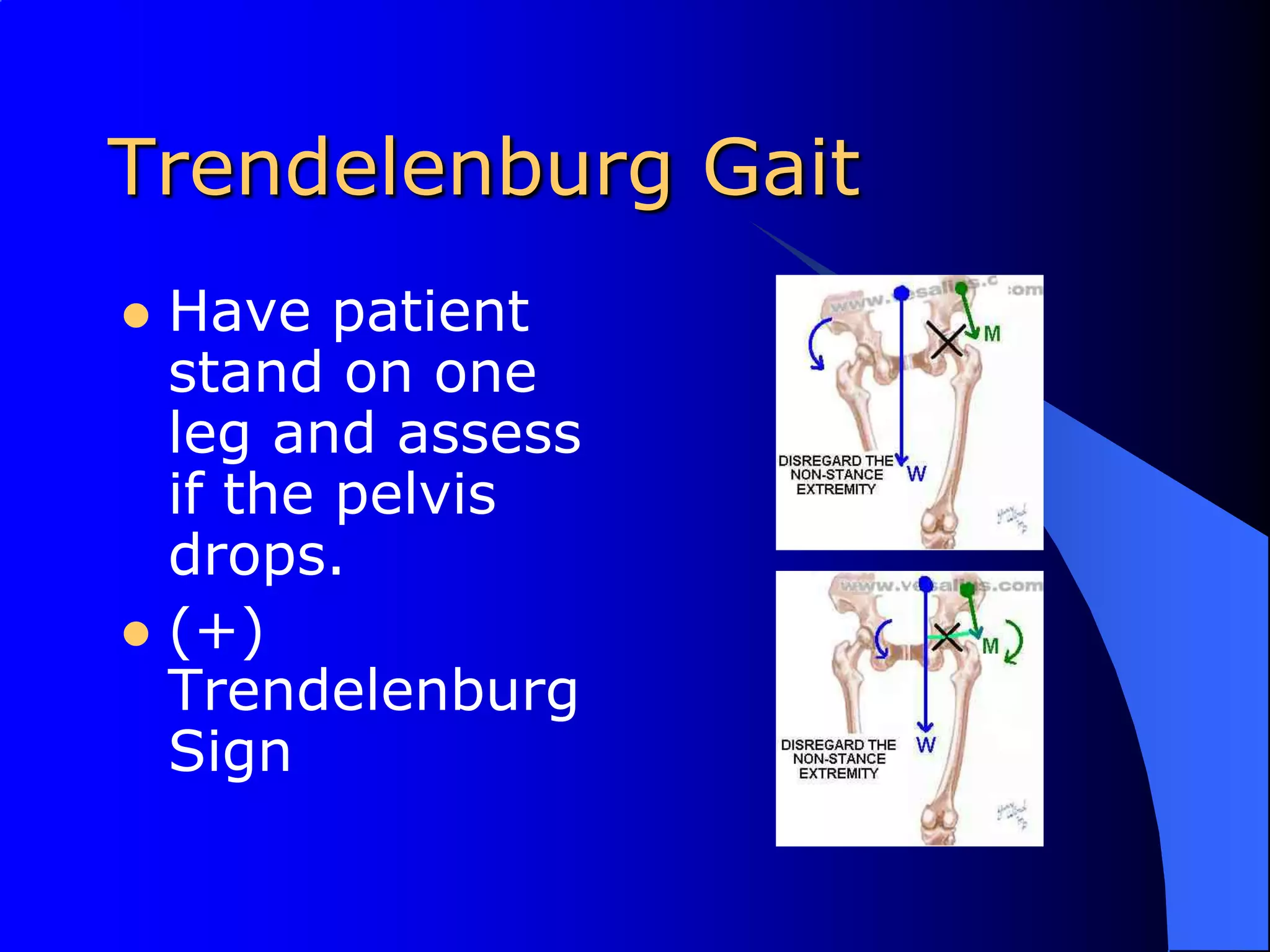 Trendelenburg GaitHave patient stand on one leg and assess if the pelvis drops.(+) Trendelenburg Sign