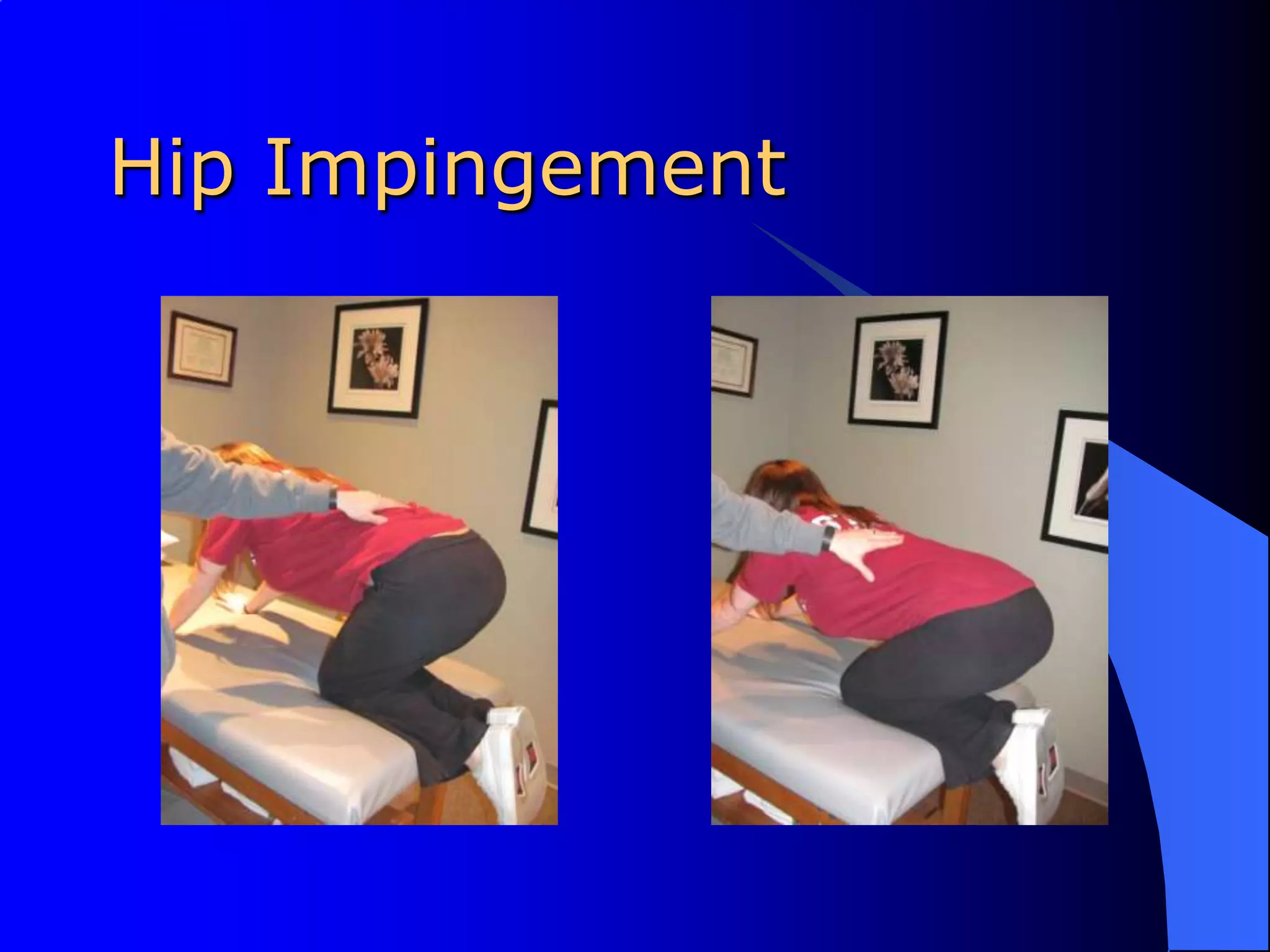 Hip Impingement