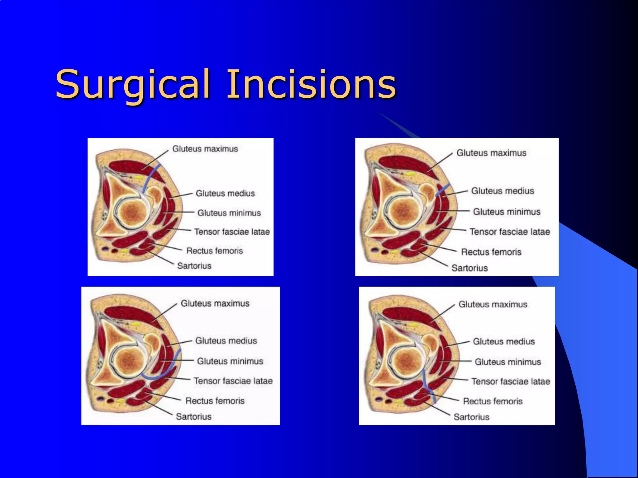 Surgical Incisions
