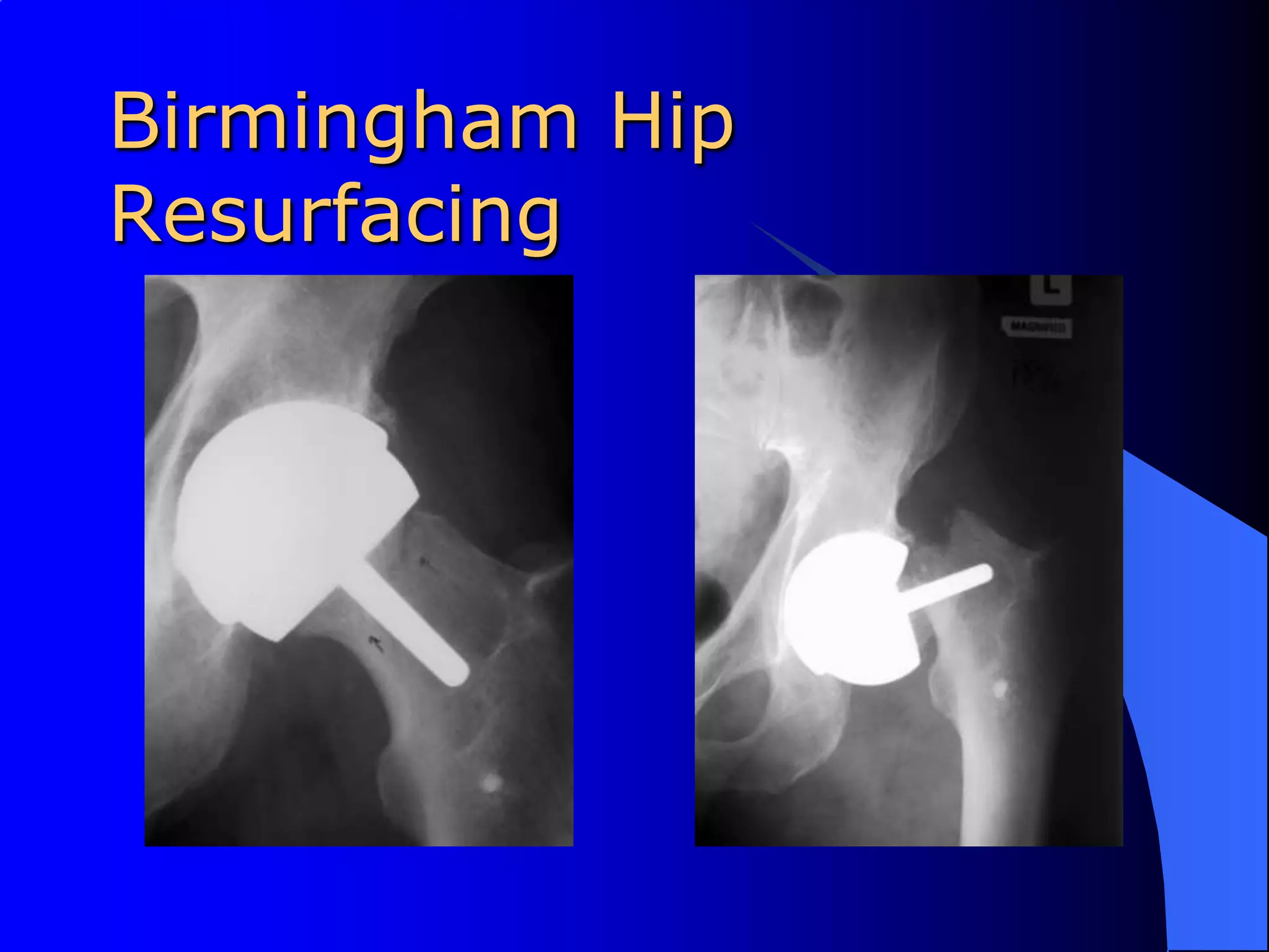 Birmingham Hip Resurfacing