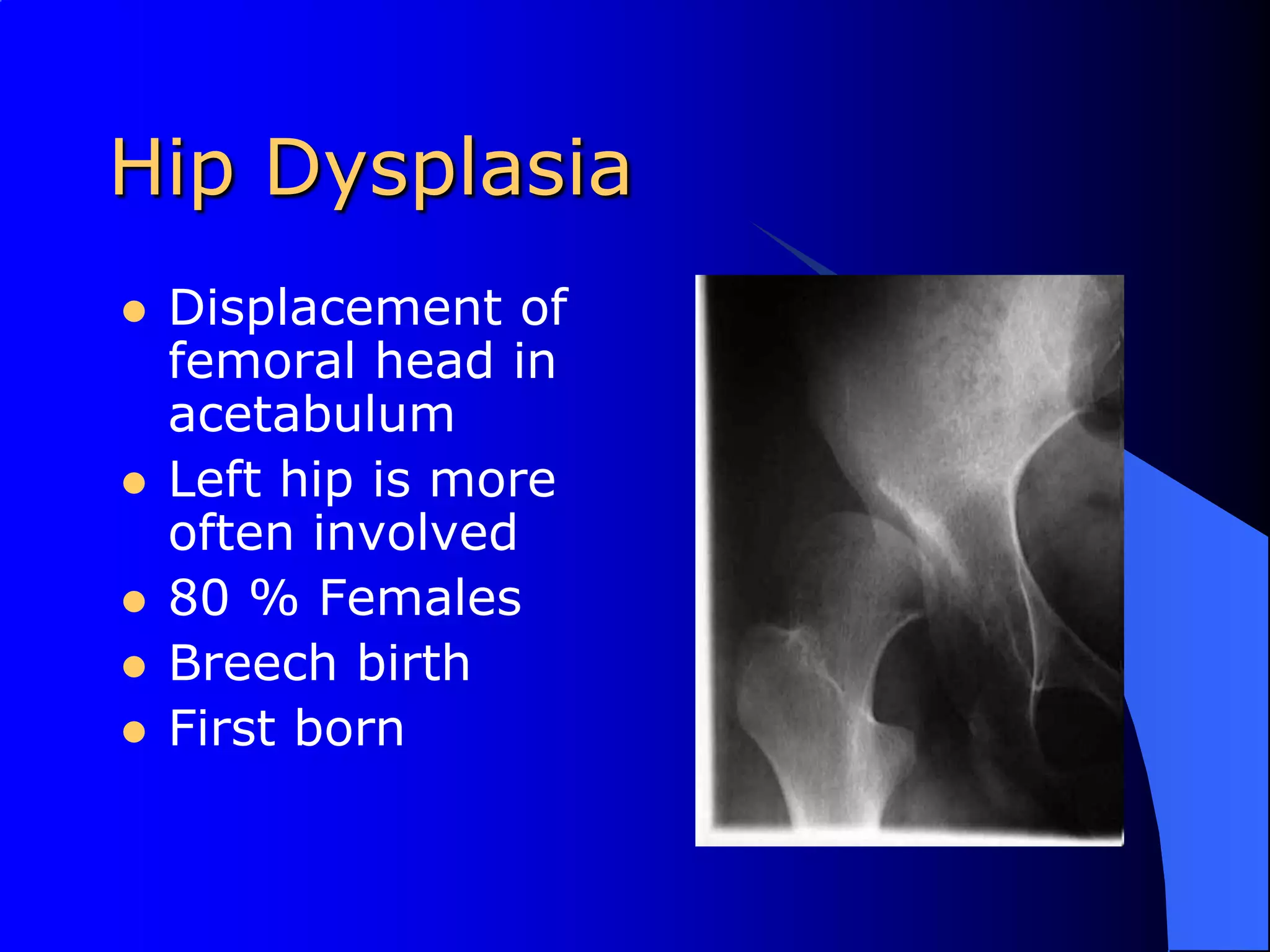 Hip DysplasiaDisplacement of femoral head in acetabulumLeft hip is more often involved80 % FemalesBreech birthFirst born