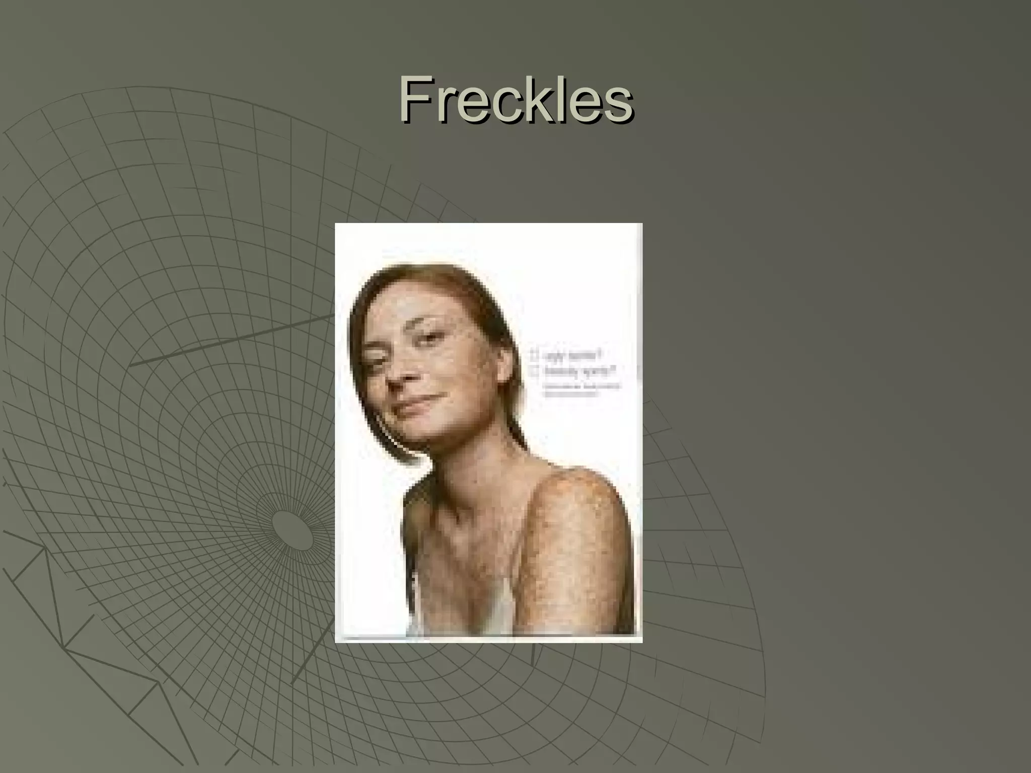 Freckles
 