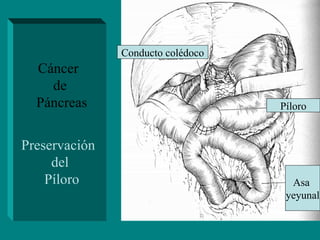 Enfermedades Qx benignas del pancreas | PPT