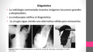 Diágnóstico
• La radiología contrastada muestra imágenes lacunares grandes
y desplazables.
• La endoscopia ratifica el diagnóstico
• La cirugía sigue siendo una alternativa válida para removerlos.
 