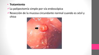 • Tratamiento
La polipectomía simple por vía endoscópica
Resección de la mucosa circundante normal cuando es sésil y
chico
 