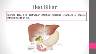 Ileo Biliar
Término dado a la obstrucción intestinal mecánica secundaria al impacto
intraluminal de un lito.
 