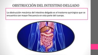 OBSTRUCCIÓNDELINTESTINODELGADO
La obstrucción mecánica del intestino delgado es el trastorno quirúrgico que se
encuentra con mayor frecuencia en esta parte del cuerpo.
 