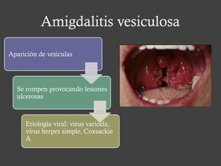 Amigdalitis vesiculosa
Aparición de vesículas
Se rompen provocando lesiones
ulcerosas
Etiología viral: virus varicela,
virus herpes simple, Coxsackie
A
 