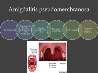 Amigdalitis pseudomembranosa
Enrojecimiento
Formación de
depósitos
fibrinógenos de
color
blango/gris
Etiología:
Virus Epstein-
Barr
Fiebre alta y
adenopatías
Dolor articular
Forma rara:
Virus C
Diphteriae
 