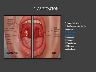 CLASIFICACIÓN
Proceso febril
 Inflamación de la
mucosa
Pudiendo
presentar:
-Eritema
- Edema
- Exudado
- Úlceras o
vesículas.
 
