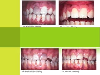 PIC.13 Before whitening     PIC.14 After whitening




PIC.15 Before of whitening     PIC.16 After whitening
 