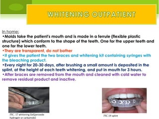 In home:
•Molds take the patient's mouth and is made in a ferrule (flexible plastic
structure) which conform to the shape of the teeth. One for the upper teeth and
one for the lower teeth.
•They are transparent, do not bother
•It gives the patient the two braces and whitening kit containing syringes with
the bleaching product.
•Every night for 20-30 days, after brushing a small amount is deposited in the
splint, at the height of each teeth whitening, and put in mouth for 3 hours.
•After braces are removed from the mouth and cleaned with cold water to
remove residual product and inactive.




   PIC. 17 whitening Gel[peroxide                   PIC.18 splint
   hydrogen or carbamide]
 
