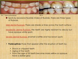 PIC. 7 Stains by fluoroscopy                   PIC.8

             Spots by excessive fluoride intake of fluoride, there are three types
             of fluorosis

        Mild dental fluorosis: There are streaks or lines across the tooth surface

        Moderate dental fluorosis: the teeth are highly resistant to decay but
          have opaque white spots

        Severe dental fluorosis: enamel is brittle and has brown spots


        • Posteruptivas those that appear after the eruption of teeth by:

               • Shock or chipped teeth
               • Aging of the tooth
               • From the age of 50 teeth become more yellow or opaque,
                 have a darker gray
 