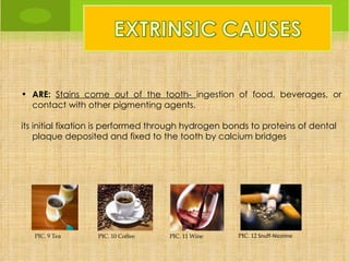 • ARE: Stains come out of the tooth- ingestion of food, beverages, or
  contact with other pigmenting agents.

its initial fixation is performed through hydrogen bonds to proteins of dental
    plaque deposited and fixed to the tooth by calcium bridges




   PIC. 9 Tea      PIC. 10 Coffee   PIC. 11 Wine     PIC. 12 Snuff-Nicotine
 
