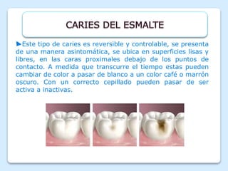 ►Este tipo de caries es reversible y controlable, se presenta
de una manera asintomática, se ubica en superficies lisas y
libres, en las caras proximales debajo de los puntos de
contacto. A medida que transcurre el tiempo estas pueden
cambiar de color a pasar de blanco a un color café o marrón
oscuro. Con un correcto cepillado pueden pasar de ser
activa a inactivas.
 