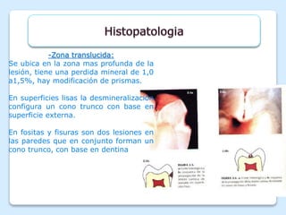 -Zona translucida:
Se ubica en la zona mas profunda de la
lesión, tiene una perdida mineral de 1,0
a1,5%, hay modificación de prismas.
En superficies lisas la desmineralización
configura un cono trunco con base en
superficie externa.
En fositas y fisuras son dos lesiones en
las paredes que en conjunto forman un
cono trunco, con base en dentina
 