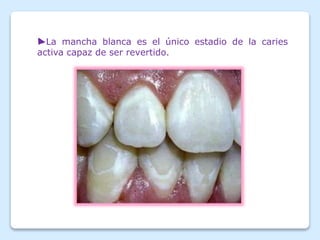 ►La mancha blanca es el único estadio de la caries
activa capaz de ser revertido.
 