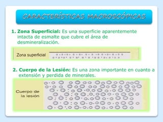 1. Zona Superficial: Es una superficie aparentemente
intacta de esmalte que cubre el área de
desmineralización.
2. Cuerpo de la Lesión: Es una zona importante en cuanto a
extensión y perdida de minerales.
 